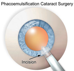 cataract surgery incision scratchy cataract surgery incision scratchy