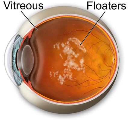 cataract surgery ink spot cataract surgery arc of light