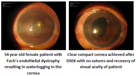 laser eye surgery dsek