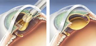 near vision after cataract surgery