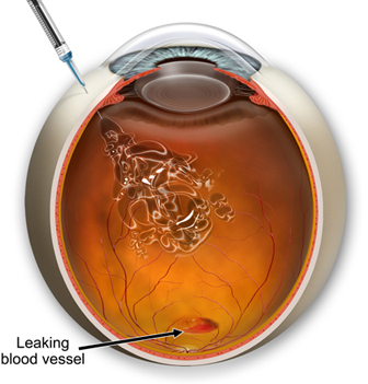 macular degeneration treatment