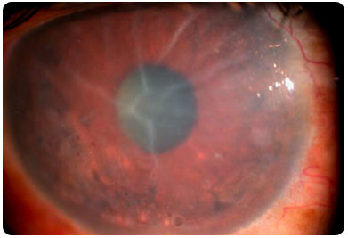 after cataract corneal edema corneal swelling