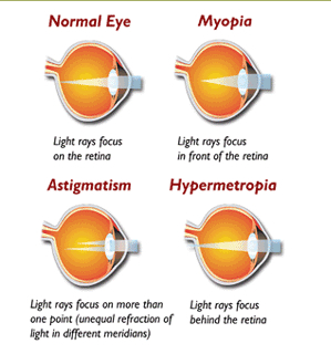 uneven vision after cataract surgery